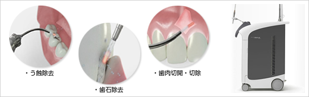 Er：YAGレーザー